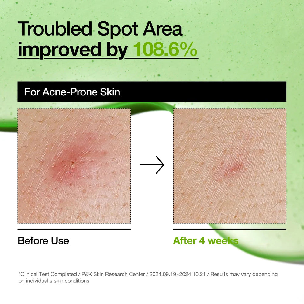 ANUA AZELAIC ACID 10+ HYALURON REDNESS SOOTHING SERUM - 30 ML